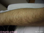 Haarentfernung Photosilk: Unterarm vorher